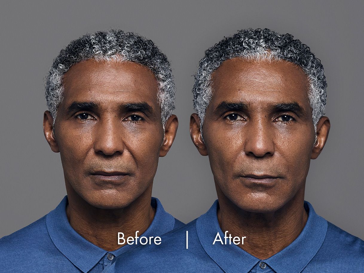 Before & After RHA fillers 1