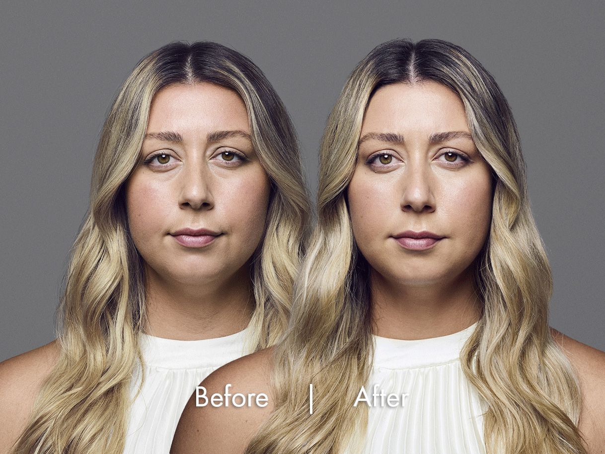 Before & After RHA fillers 2