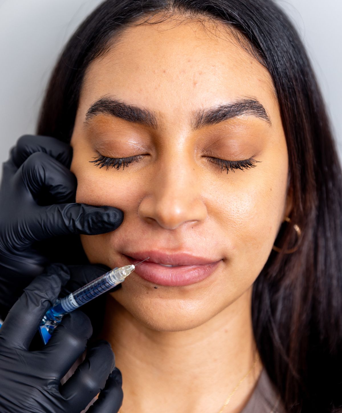 lip filler patient model receiving an injection to her top lip