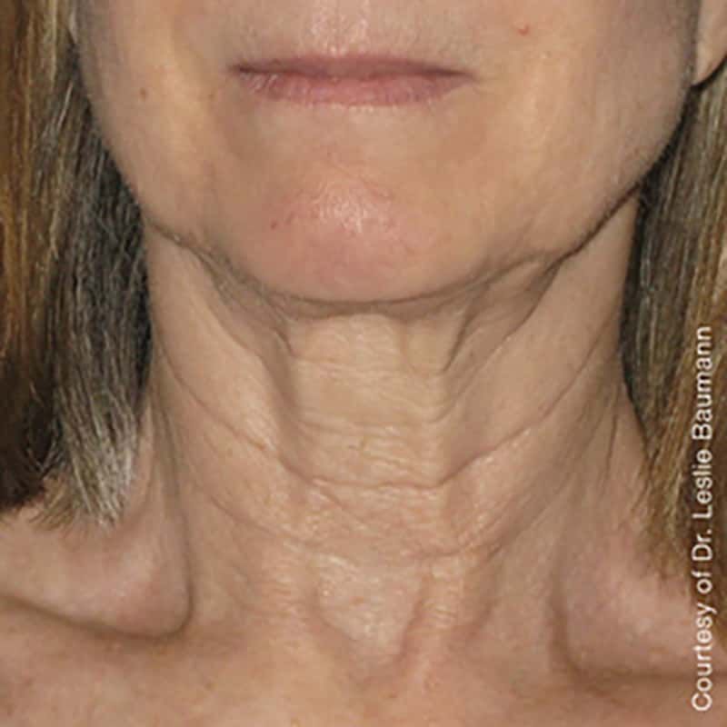 Ultherapy Gallery Before & After