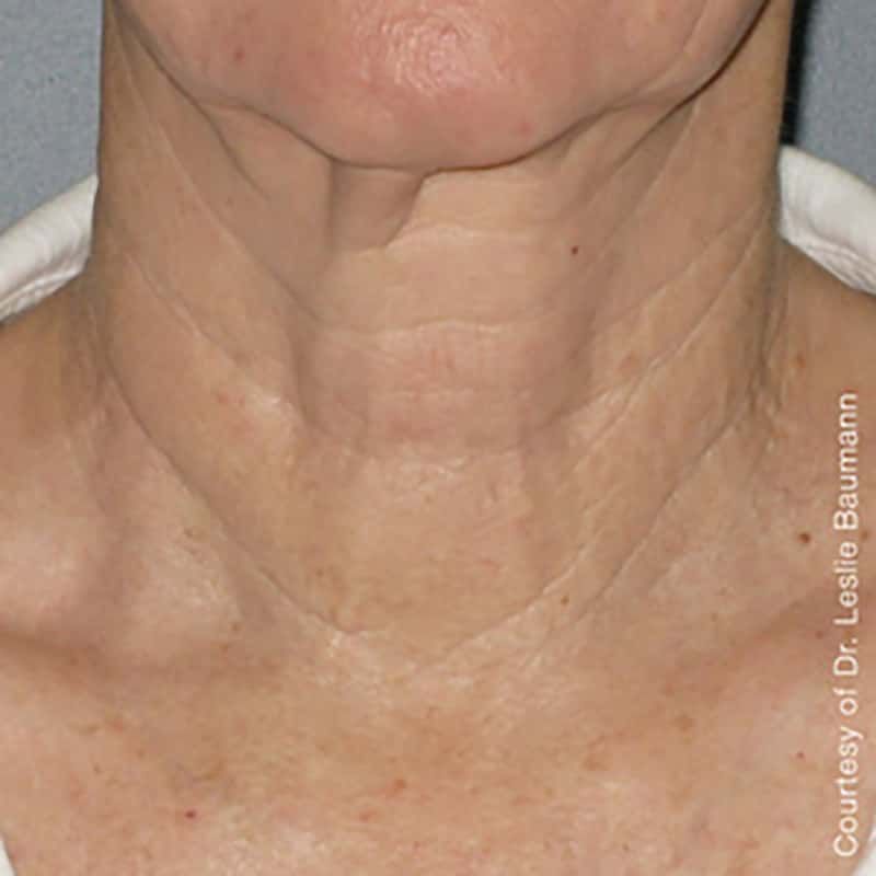 Ultherapy Gallery Before & After